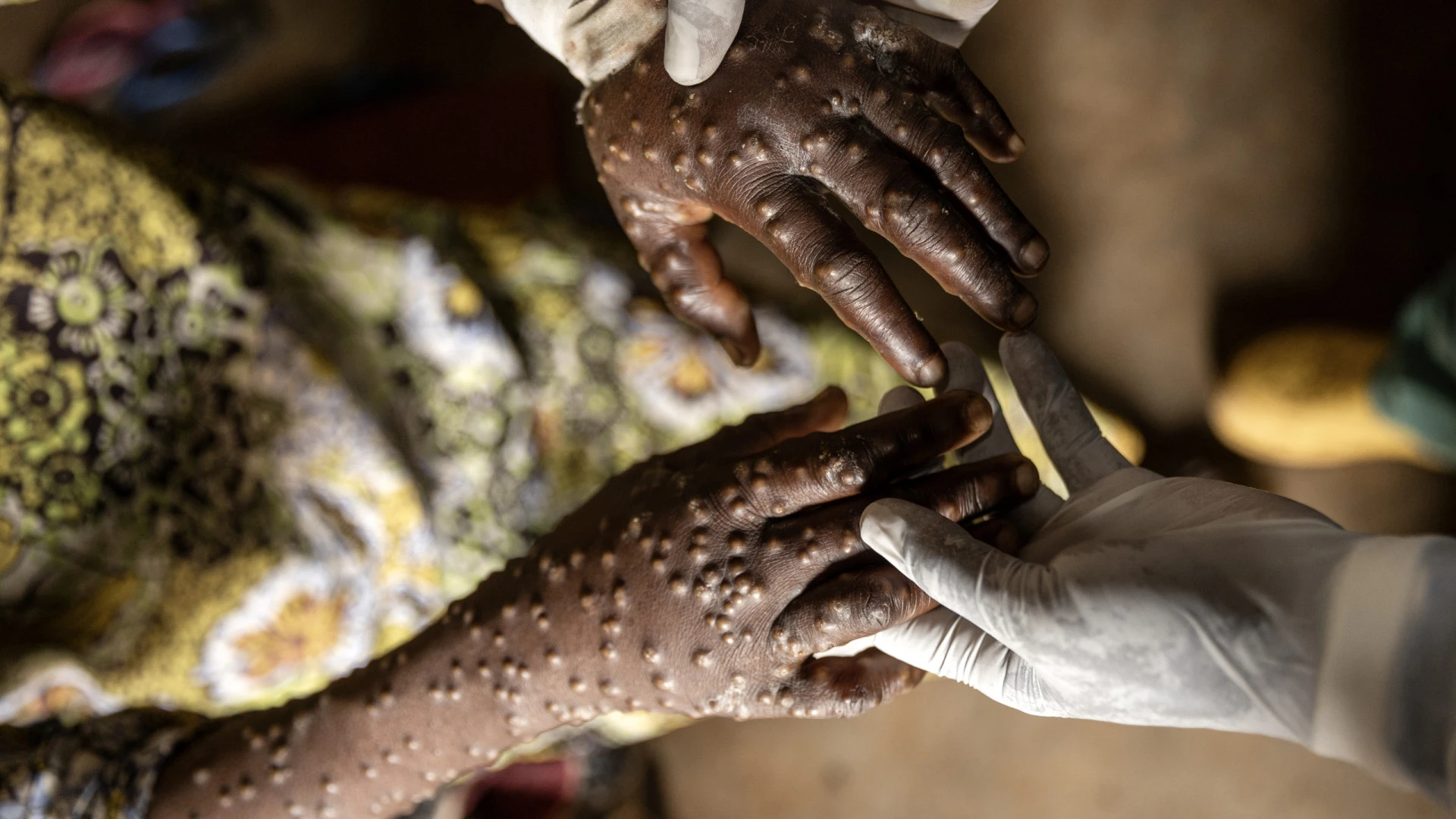 Moçambique regista sete novos casos de mpox e 36 suspeitas