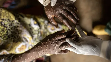 Moçambique regista sete novos casos de mpox e 36 suspeitas