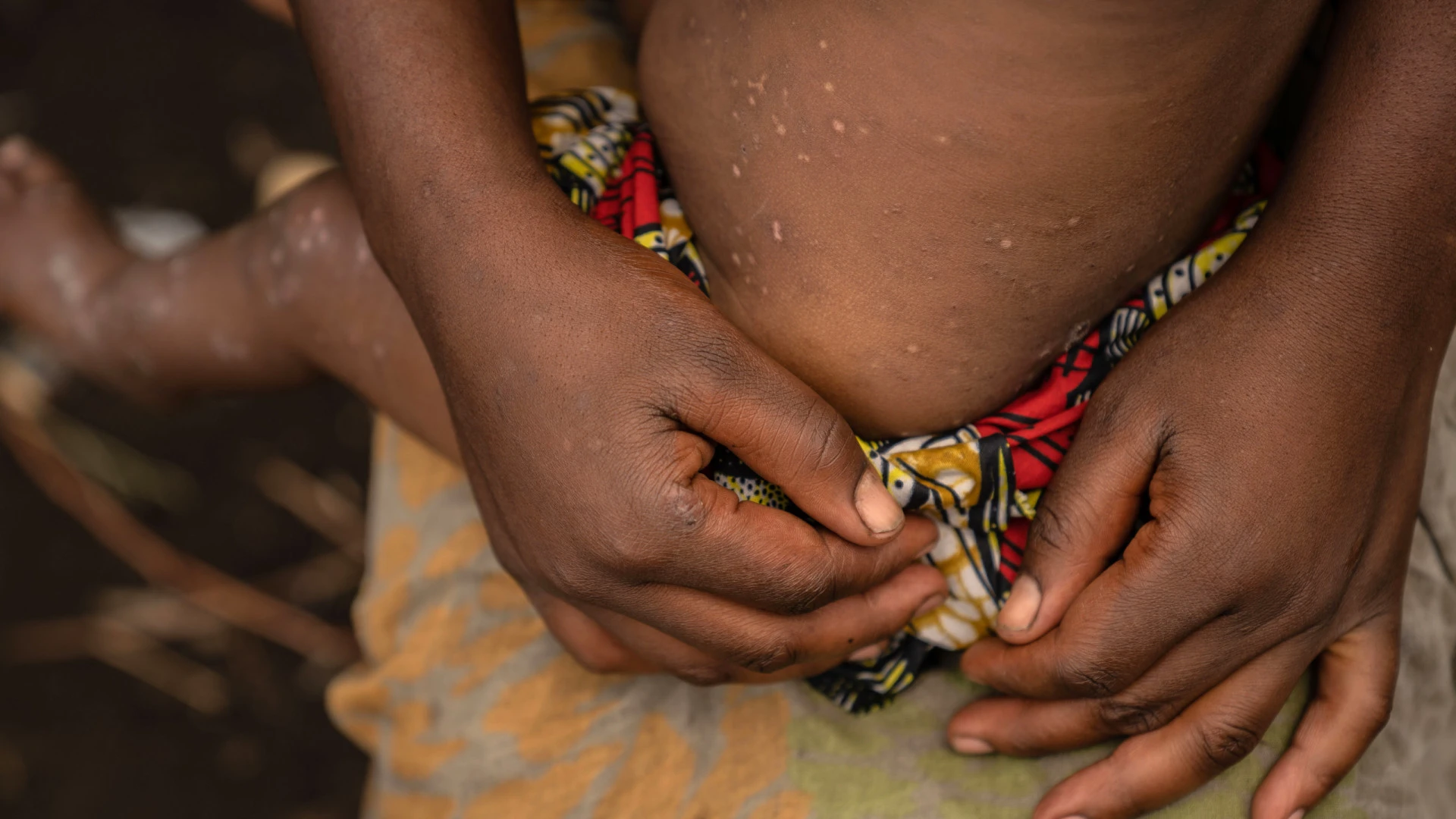 Moçambique enfrenta aumento de casos de mpox com novas medidas de contenção