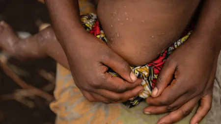 Moçambique enfrenta aumento de casos de mpox com novas medidas de contenção