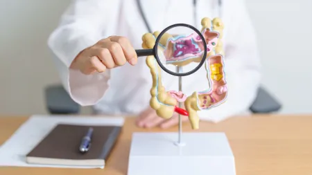 Diferenças Cruciais entre Cancro Colorretal e Síndrome do Intestino Irritável