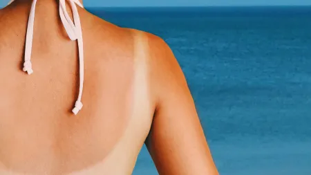Protege-te do Sol: Zonas em Risco de Queimaduras e Dicas de Prevenção
