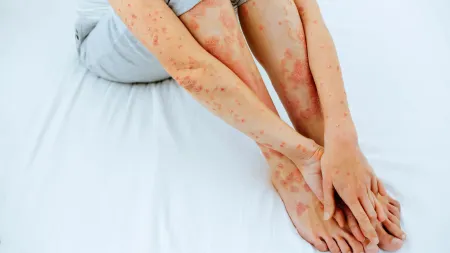 Psoríase: Uma condição autoimune exacerbada pelo stress